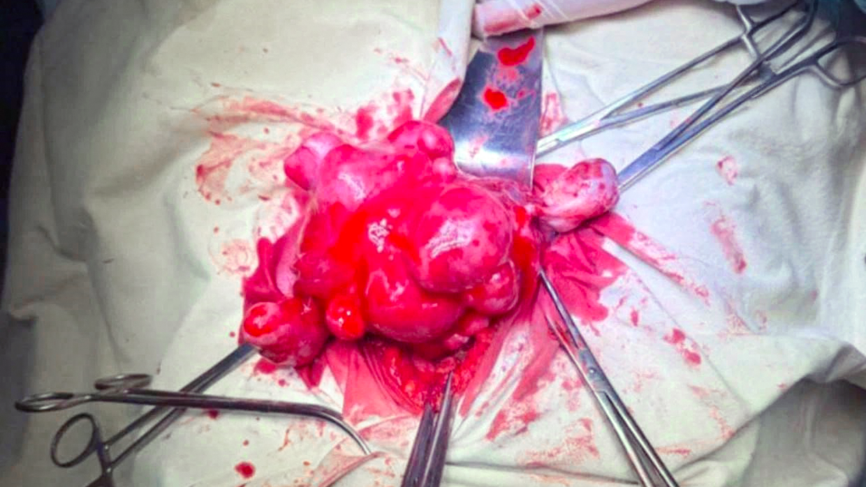 В Москве женщине удалили 32 миоматозных узла, сохранив матку В Москве женщине удалили 32 миоматозных узла, сохранив матку