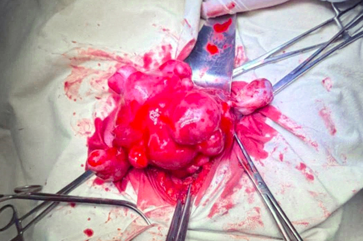 В Москве женщине удалили 32 миоматозных узла, сохранив матку