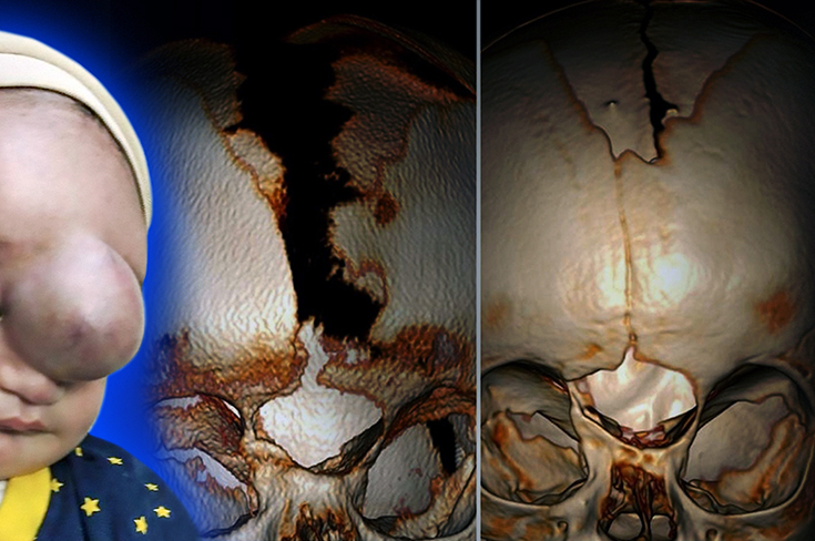 В Москве помогли мальчику с огромным новообразованием на лбу