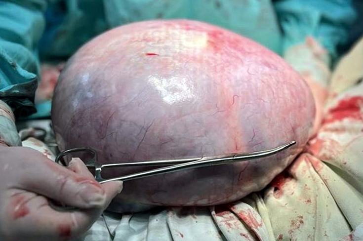 В ГКБ Ерамишанцева удалили полуметровую опухоль яичника, которая чуть не лишила женщину конечности