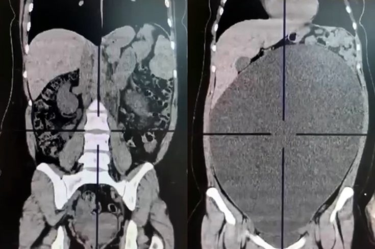 Врачи удалили 40-сантиметровую кисту яичника, сохранив орган