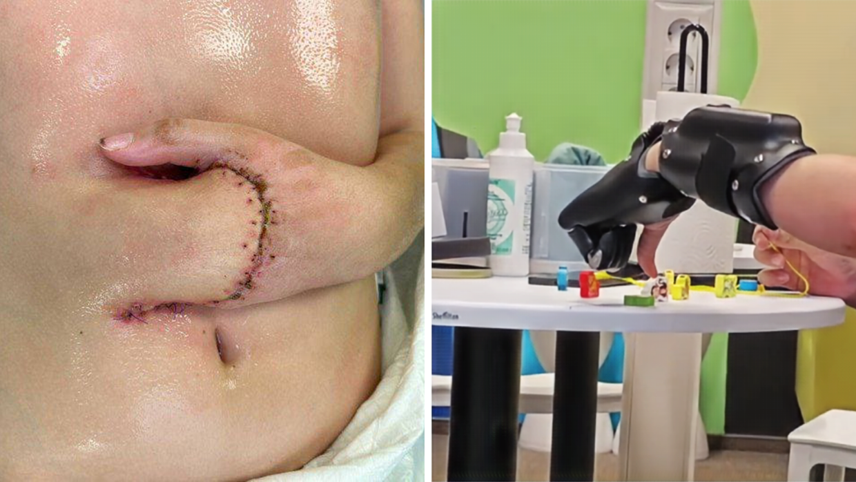 В Коммунарке спасли ребенка, пришив руку к животу В Коммунарке спасли ребенка, пришив руку к животу