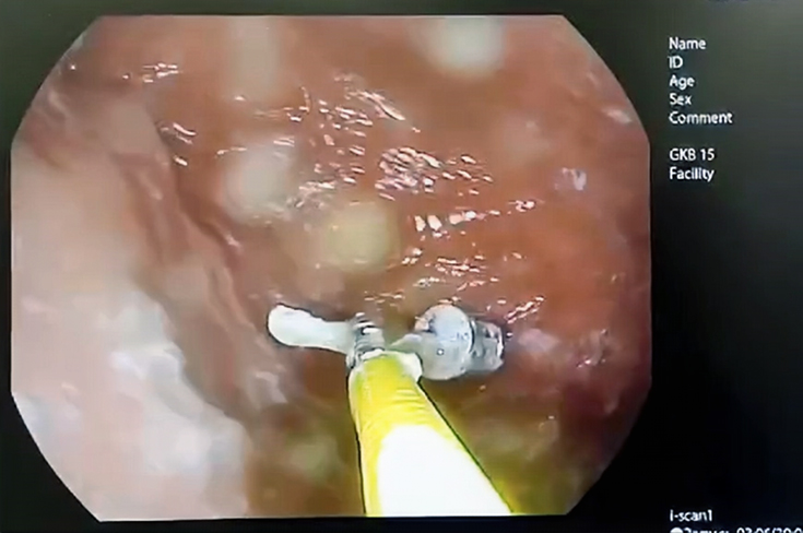 Врачи помогли женщине, проглотившей насадку от бормашины во время лечения зубов