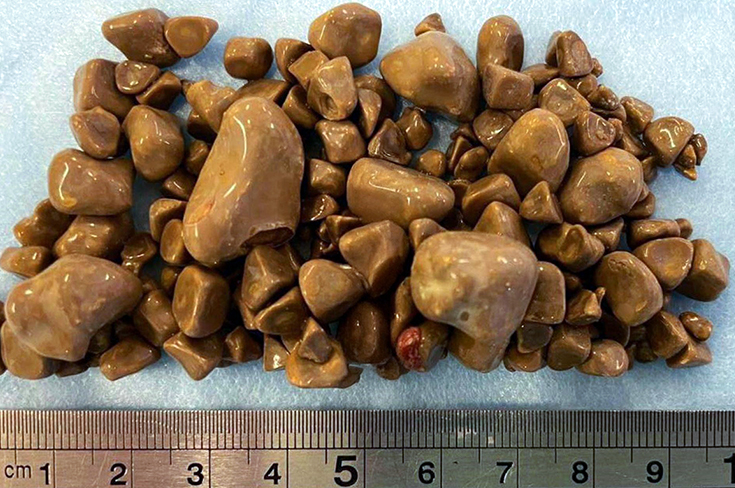 Московские хирурги удалили более 100 камней из почек женщины