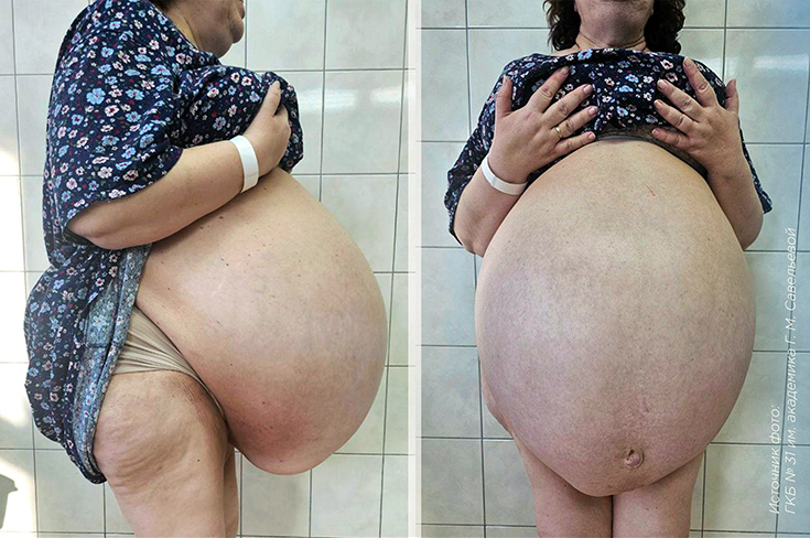 40-литровую кисту печени удалили женщине в больнице Савельевой