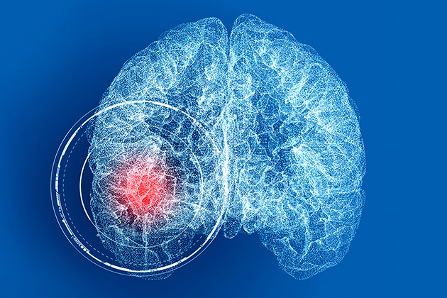 Аневризма головного мозга — жизнь на пороховой бочке