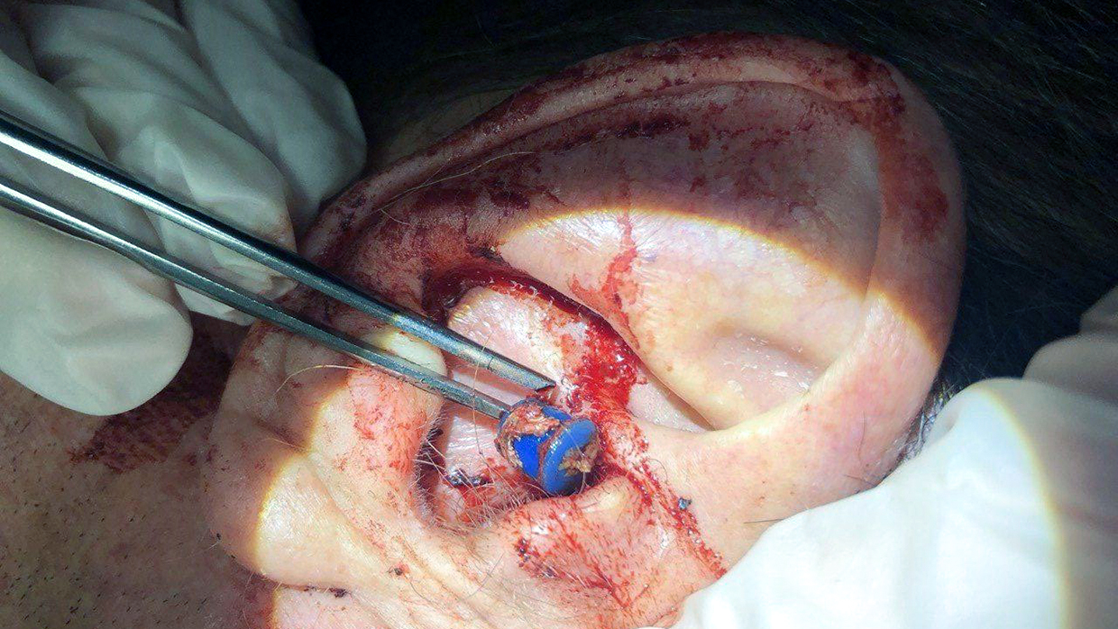 Думали инсульт, а оказалось ручка в ухе — необычная находка в Первой Градской больнице Думали инсульт, а оказалось ручка в ухе — необычная находка в Первой Градской больнице