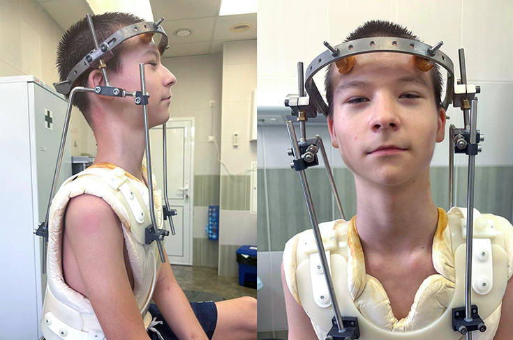 В Москве помогли подростку, который несколько месяцев жил со сломанным позвонком