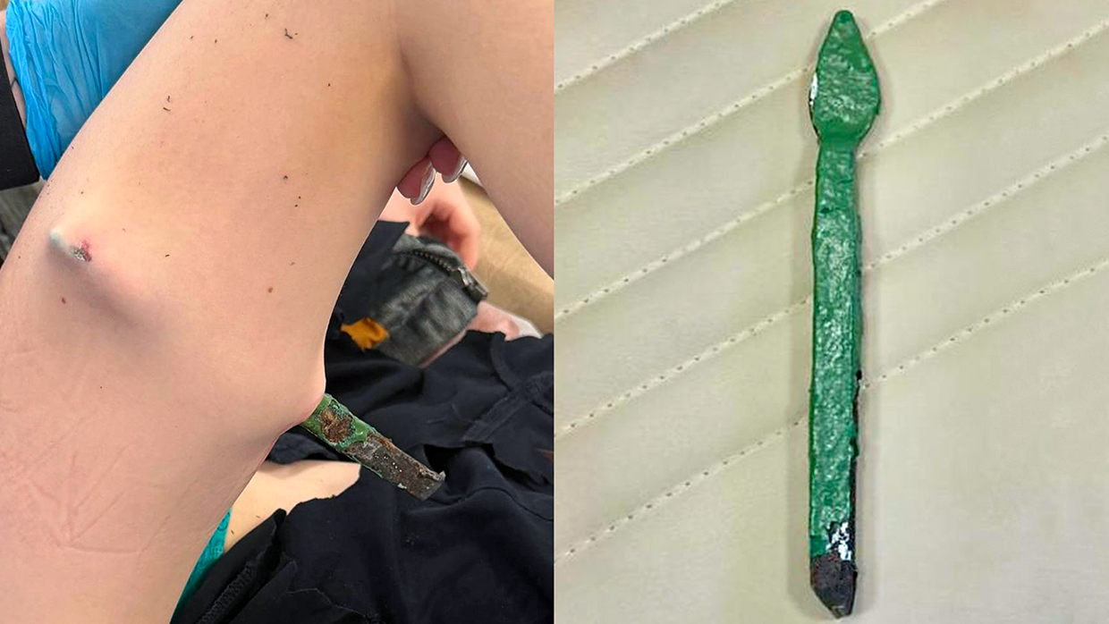 В Москве врачи извлекли из ребенка часть школьного железного забора В Москве врачи извлекли из ребенка часть школьного железного забора