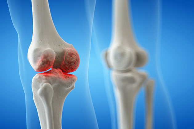 Лечение разрыва мениска: удалять или  сшивать?