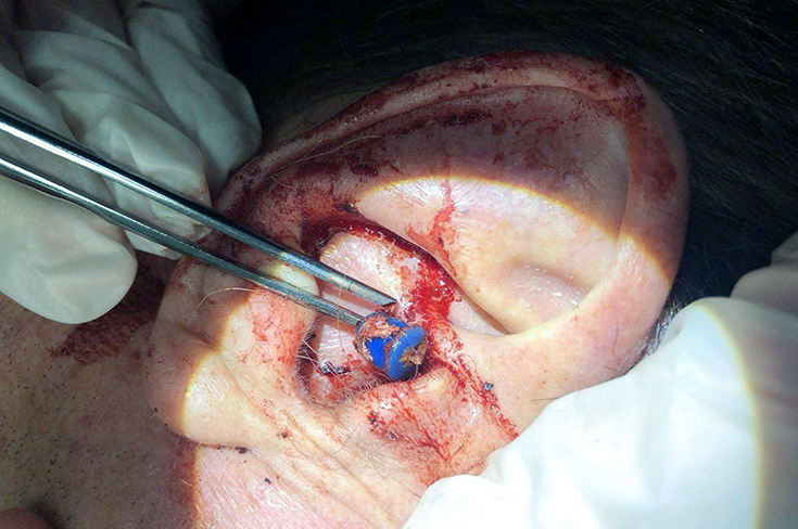 Думали инсульт, а оказалось ручка в ухе — необычная находка в Первой Градской больнице