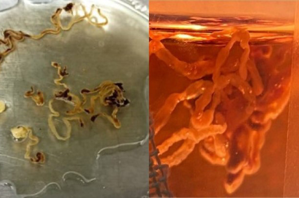 В Москве у 35-летней женщины удалили гигантский тромб длиной 25 см