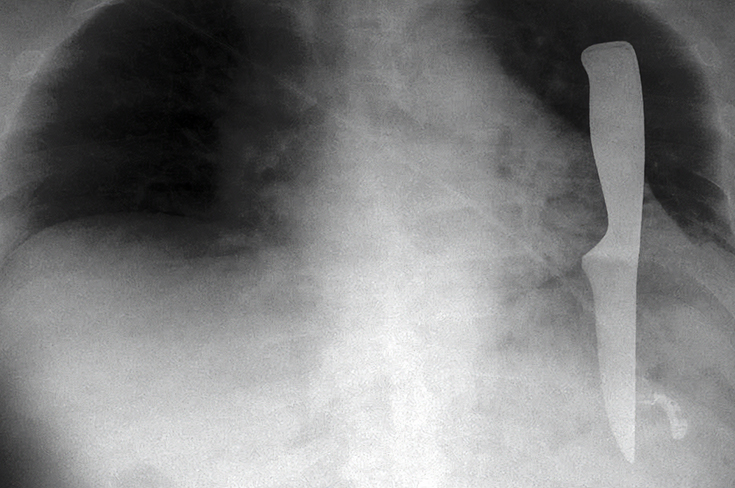 В Первой градской больнице в легком мужчины нашли кухонный нож