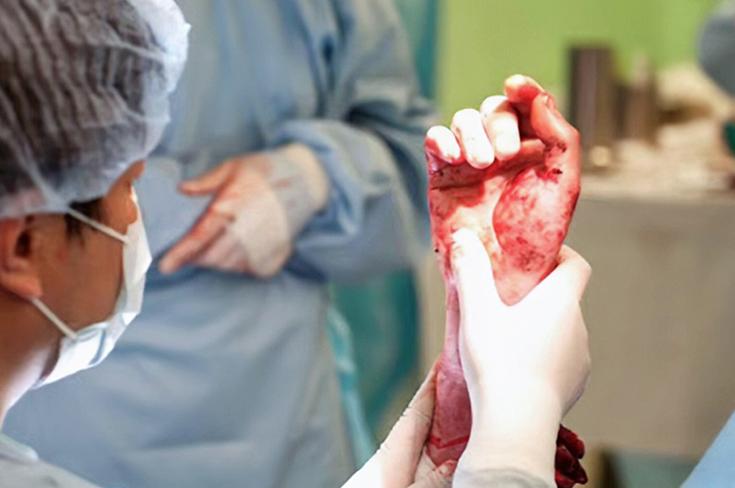 В Москве врачи успешно пересадили руки 42-летнему мужчине