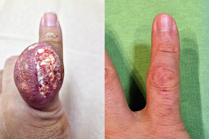 В больнице им. А.К.Ерамишанцева пациента избавили от огромного тофуза на мизинце