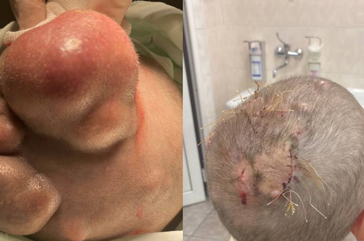 Образования размером с мяч для гольфа удалили на голове женщины хирурги больницы Вересаева