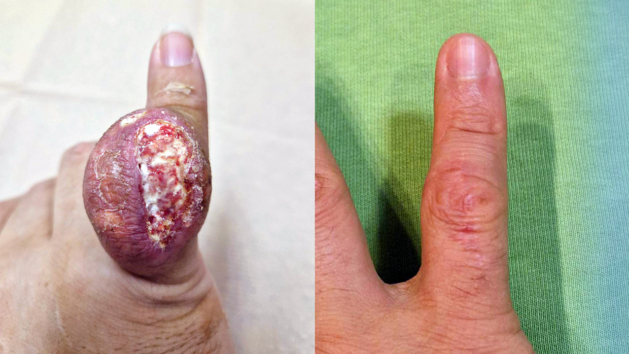 В больнице им. А.К.Ерамишанцева пациента избавили от огромного тофуза на мизинце В больнице им. А.К.Ерамишанцева пациента избавили от огромного тофуза на мизинце