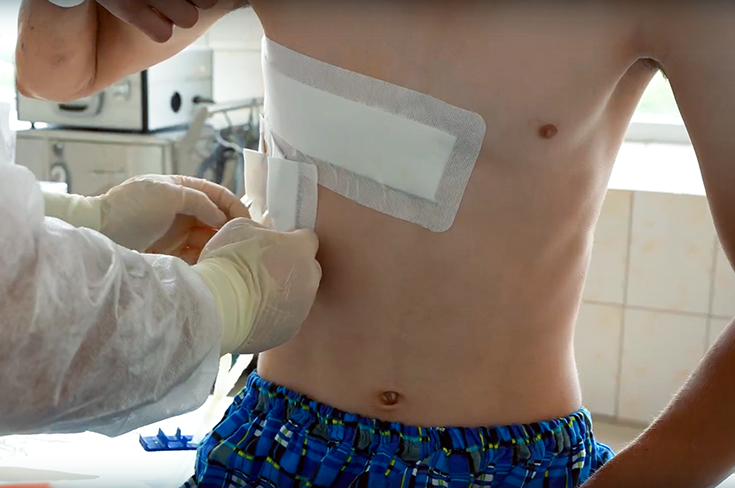 В Склифе спасли пациента, упавшего на арматуру, которая проткнула его тело насквозь