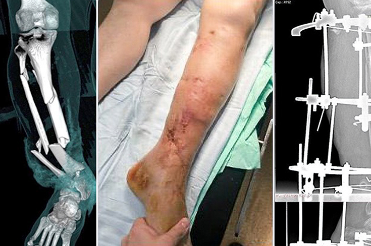 Врачи больницы Ерамишанцева помогли мужчине, ногу которого засосало в станок на производстве