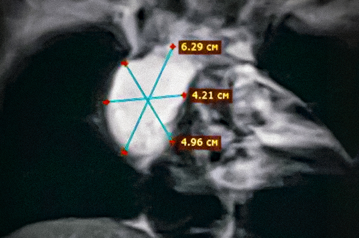 В Москве спасли подростка с опухолью в грудной клетке