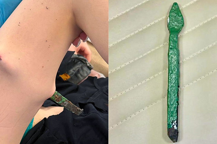 В Москве врачи извлекли из ребенка часть школьного железного забора