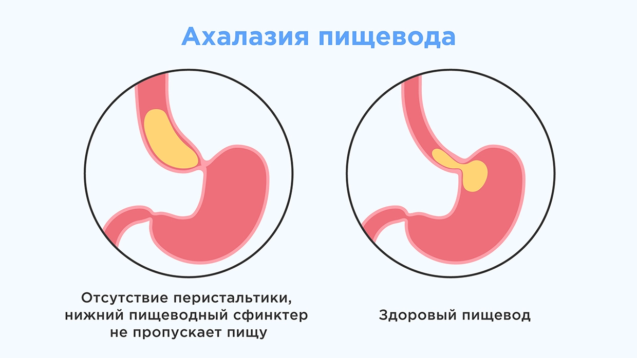 Затрудненное глотание (дисфагия)