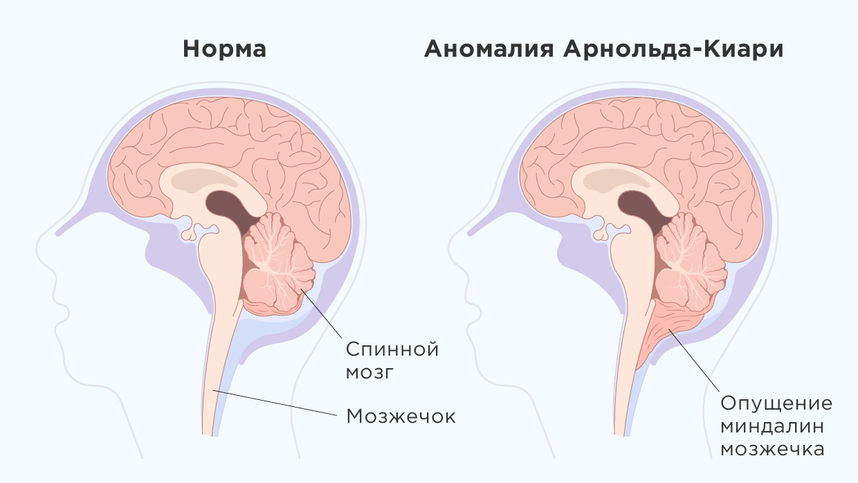 Аномалия арнольда киари операция