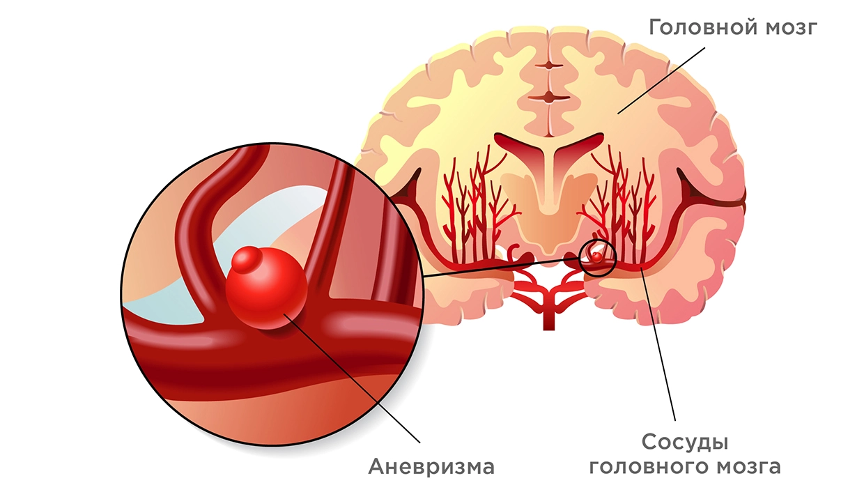 Аневризма сосудов головного мозга – симптомы, причины, диагностика и лечение в лучших клиниках
