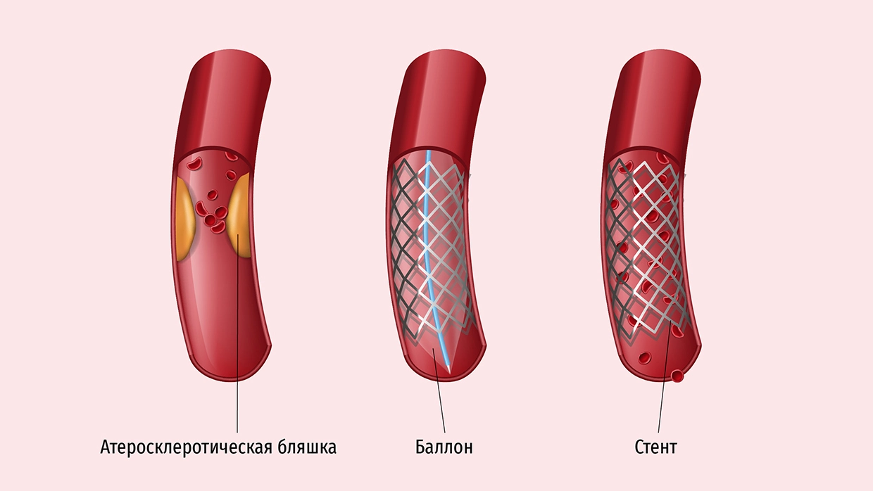 Стенд коронарных сосудов. Стентирование коронарных артерий. Стентирование коронарных сосудов. Баллонная ангиопластика и стентирование. Баллонная ангиопластика коронарных артерий.