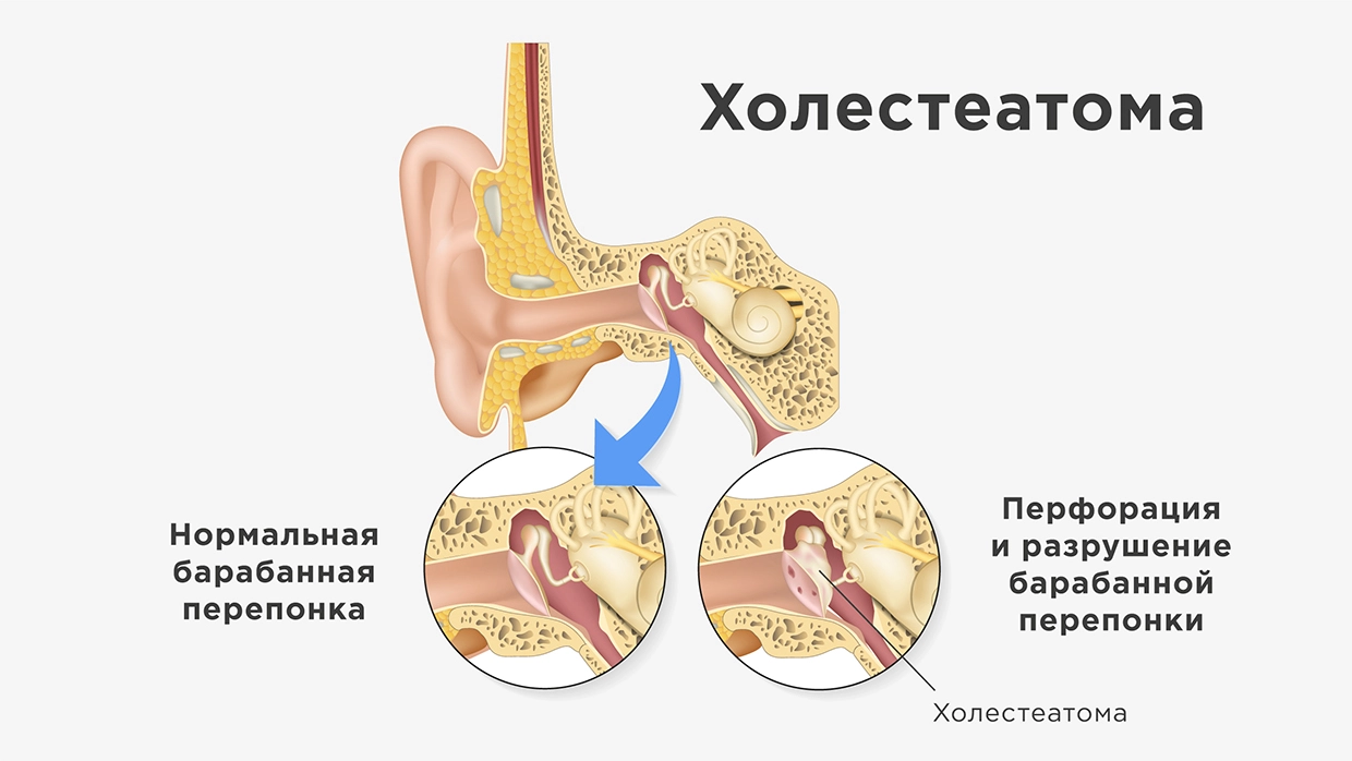 Боль в ухе: симптомы, причины, виды, осложнения и методы лечения в «СМ-Клиника»