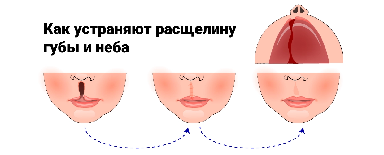 Заячья Губа Волчья Пасть Фото Детей