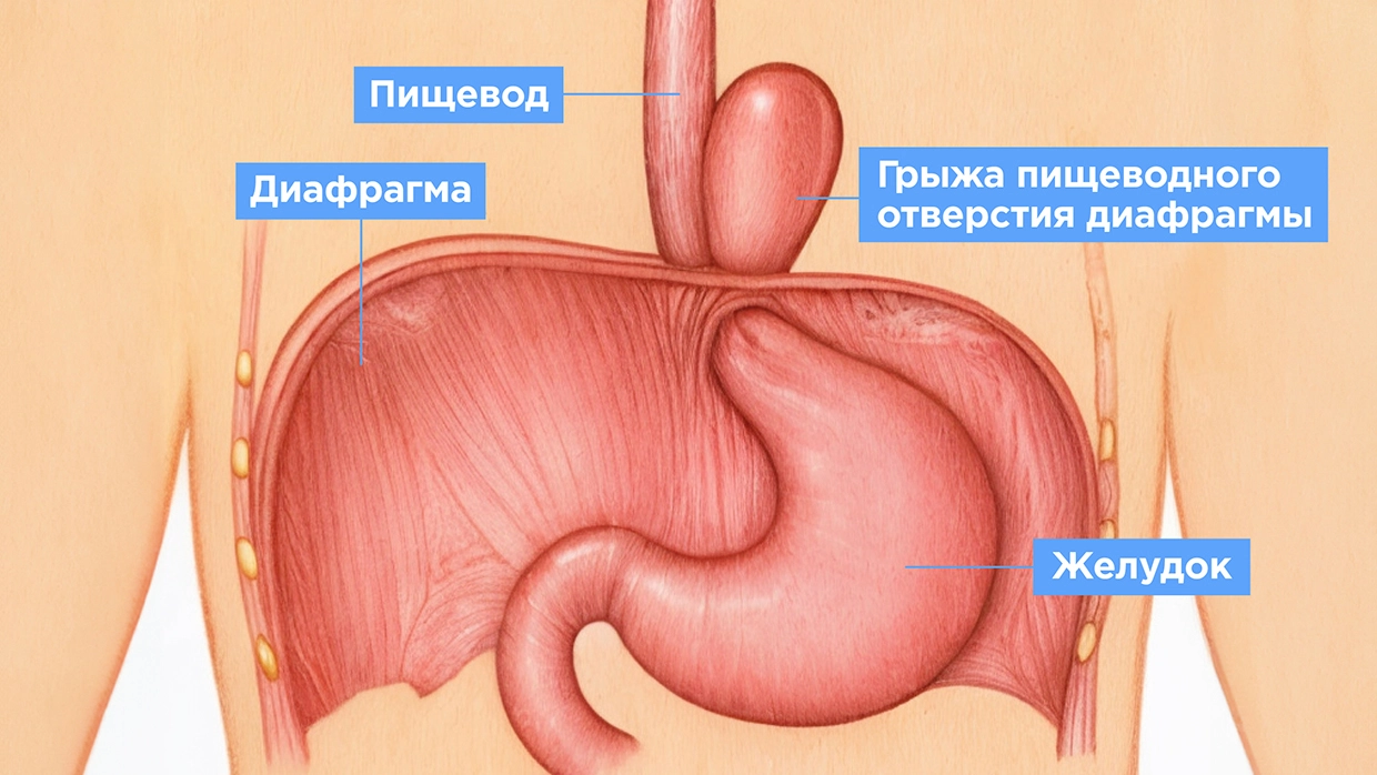 Методы сужения влагалища