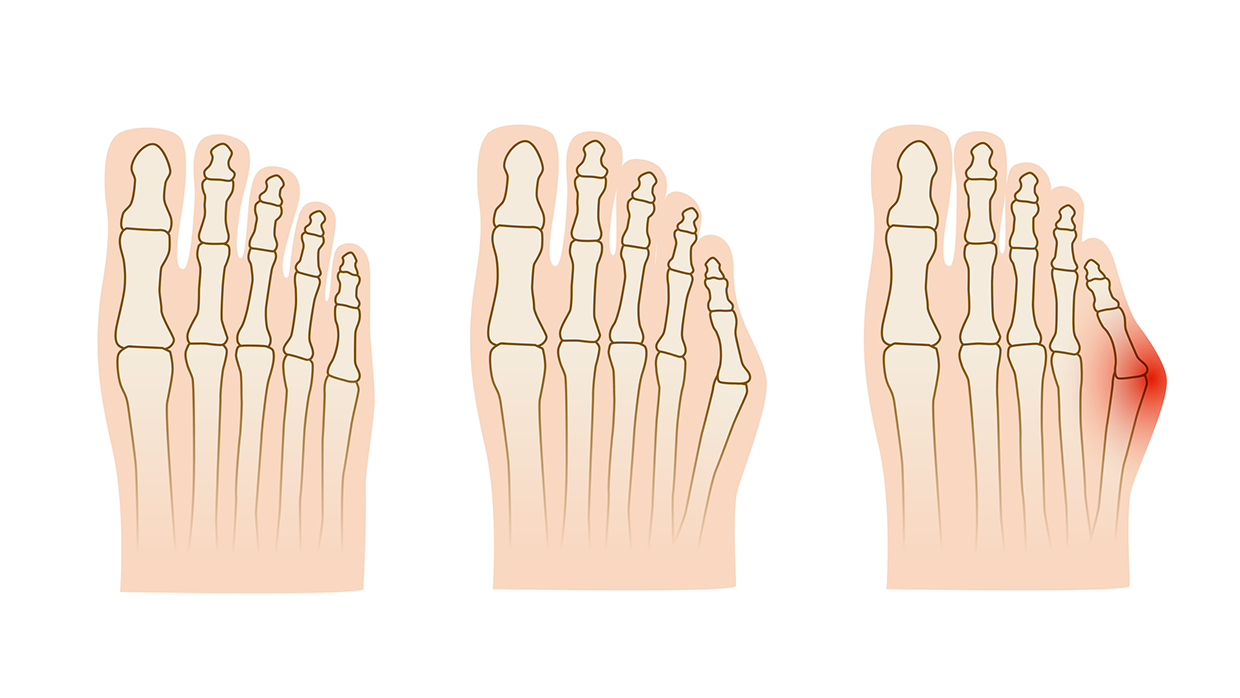 Деформация пятого пальца стопы или деформация Тейлора.