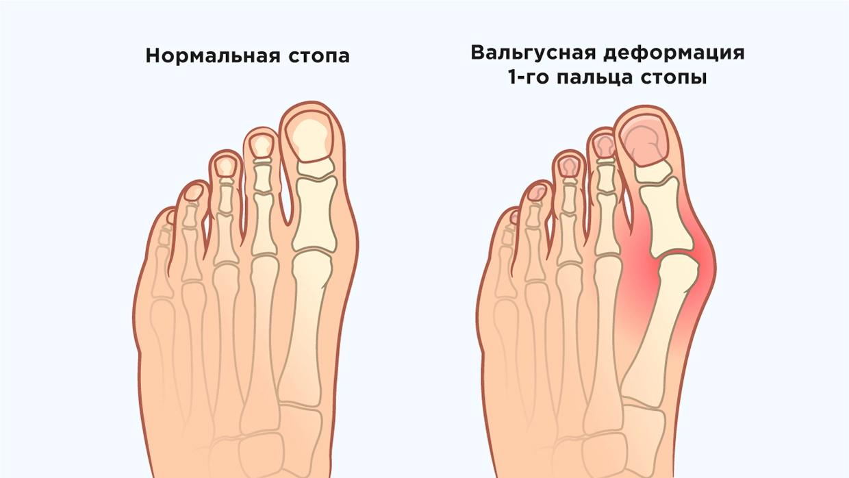 Вальгусная деформация стопы. Вальгусная деформация стопы у взрослых. Малоинвазивная операция вальгусной деформации стопы. Стельки при вальгусной деформации большого пальца.