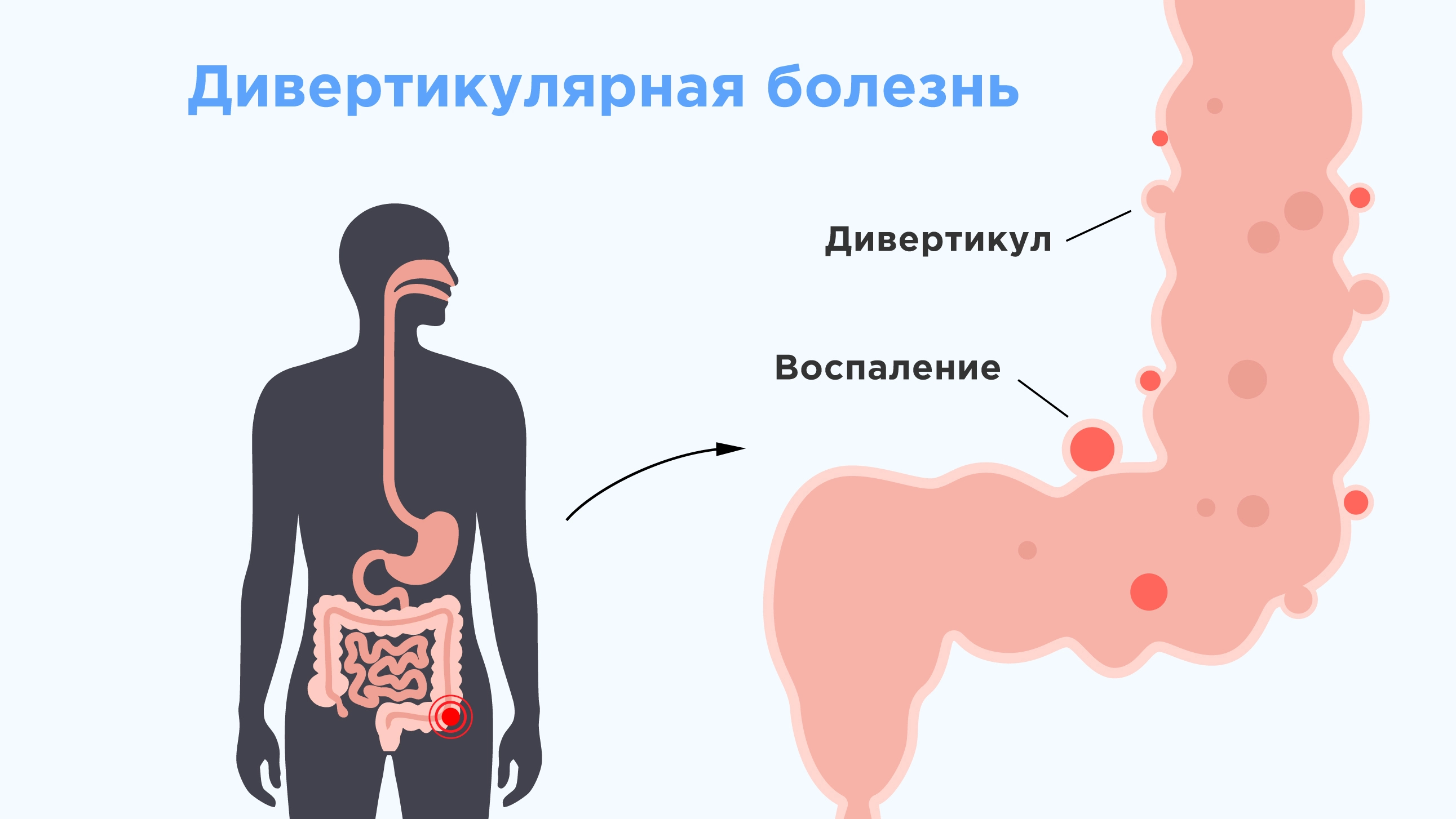 Дивертикулярная болезнь