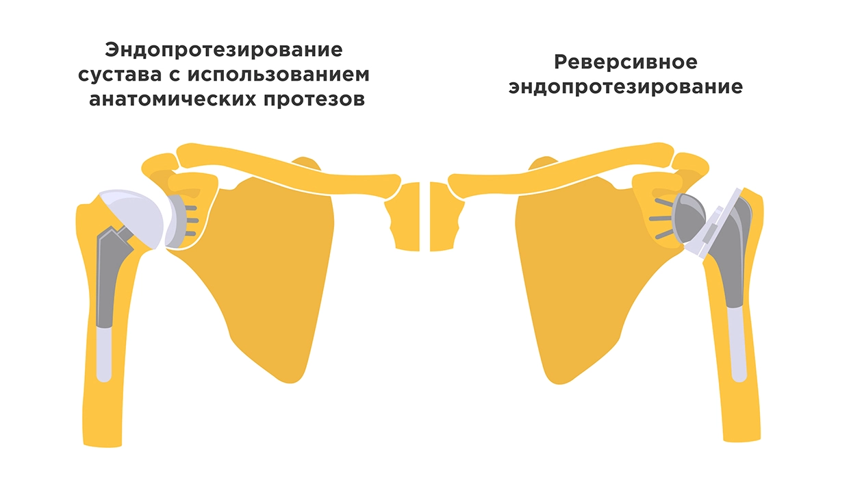 Артроскопия плечевого сустава в Москве - цена артроскопии плеча в Клиническом Госпитале на Яузе