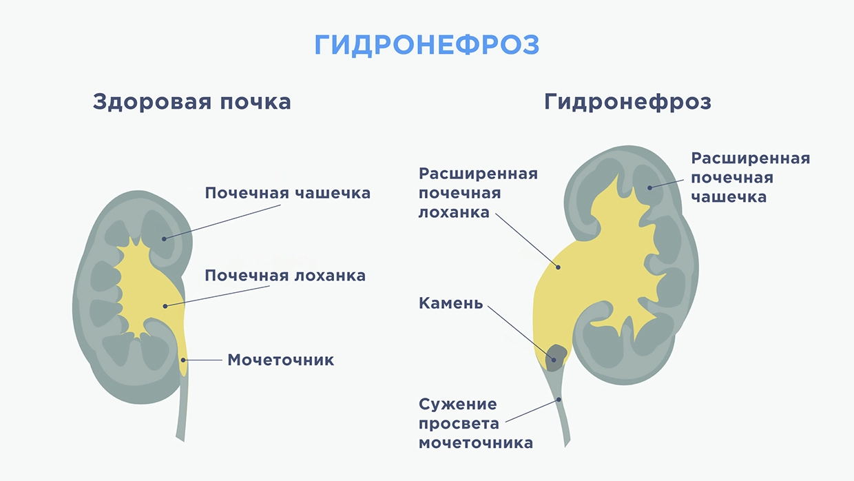 Осложнения гидронефроза. Гидронефроз классификация. Степени гидронефроза на кт. Стриктура мочеточника симптомы.