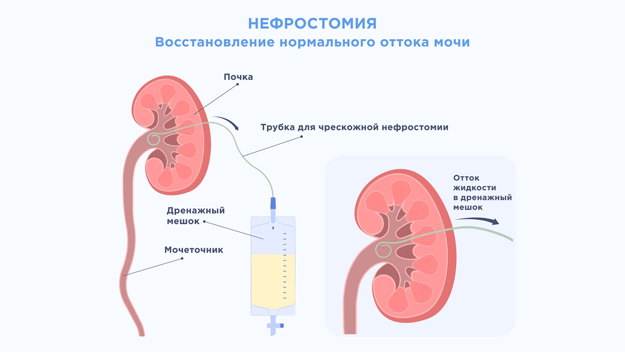 Осложнения гидронефроза