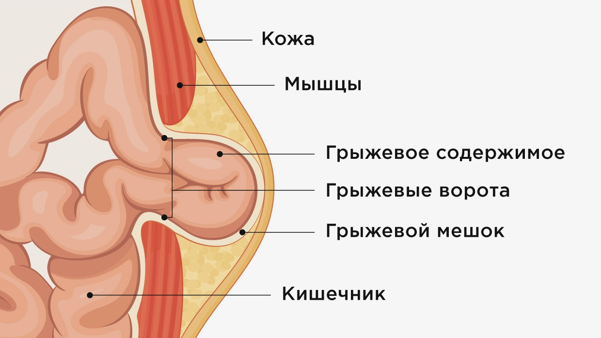 Грыжа слева внизу живота у женщин симптомы. Послеоперационная вентральная грыжа. Послеоперационная вентральная грыжа на УЗИ. UHB;F.