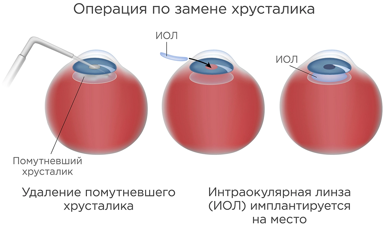 Операция по замене хрусталика Операция по замене хрусталика