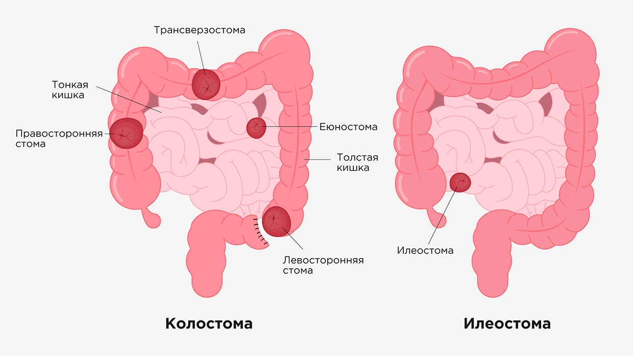 Илеостома при онкологии кишечника – различные формы, наложение и уход в Москве