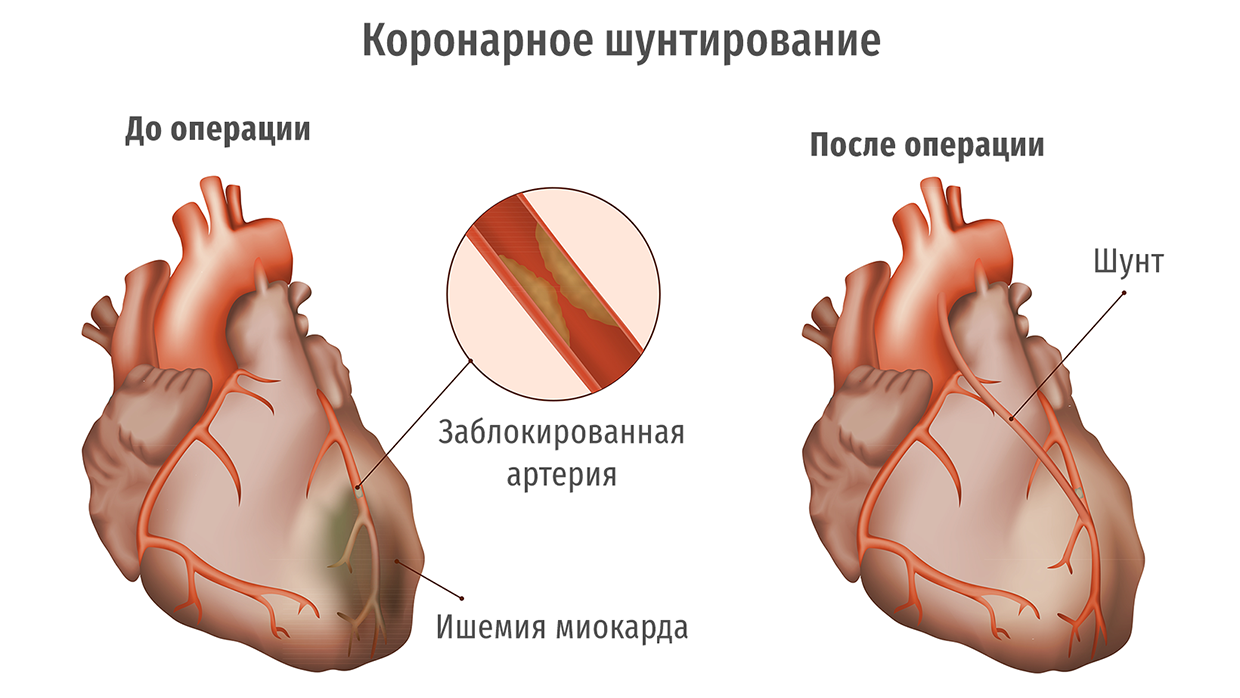 Коронарное шунтирование. Шунтирование коронарных артерий. Атеросклероз коронарных артерий сердца. Аортокоронарное шунтирование ЭФЛЕР. Нарушение коронарного кровообращения.