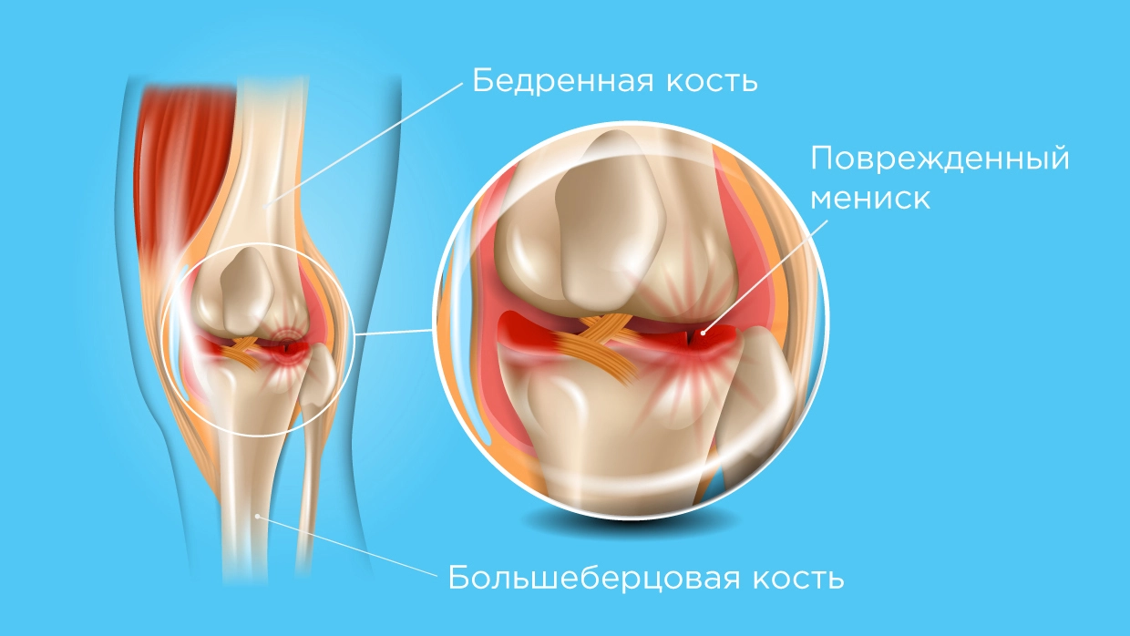 Лечение мениска