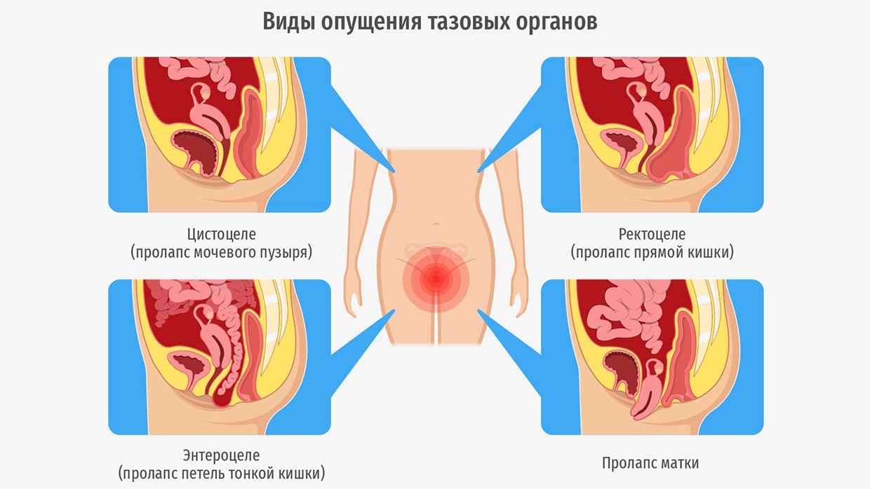 Опущение матки картинки