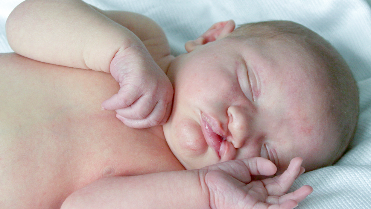 Расщелина губы и неба у детей.