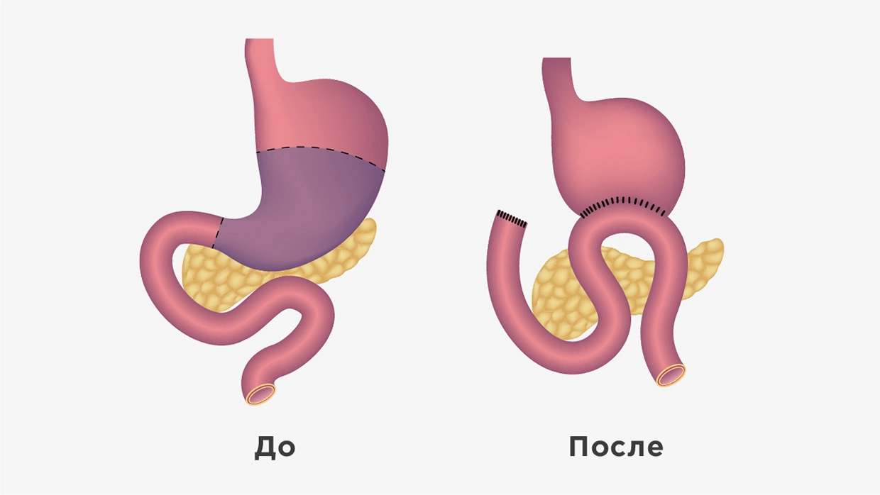 Желудок до и после проведения резекции по методу Бильрот 2