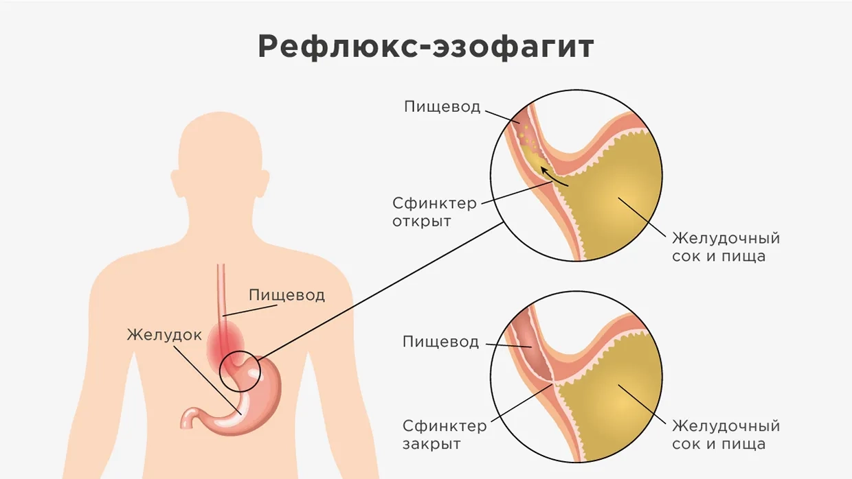 Боль в пищеводе после еды. Пострезекционные синдромы. Осложнения после резекции желудка. Язва малой кривизны желудка. Анемия при резекции желудка.