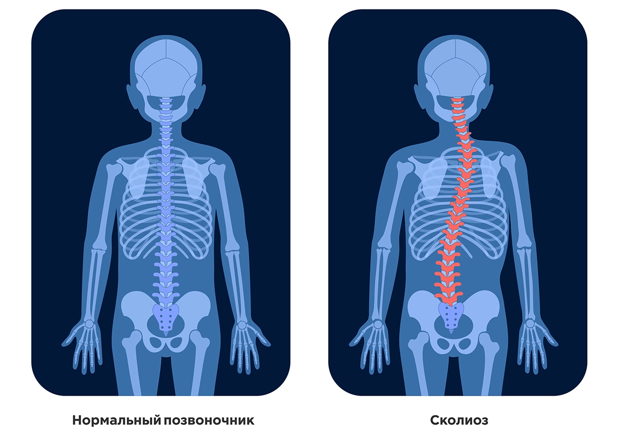 Классификация сколиоза