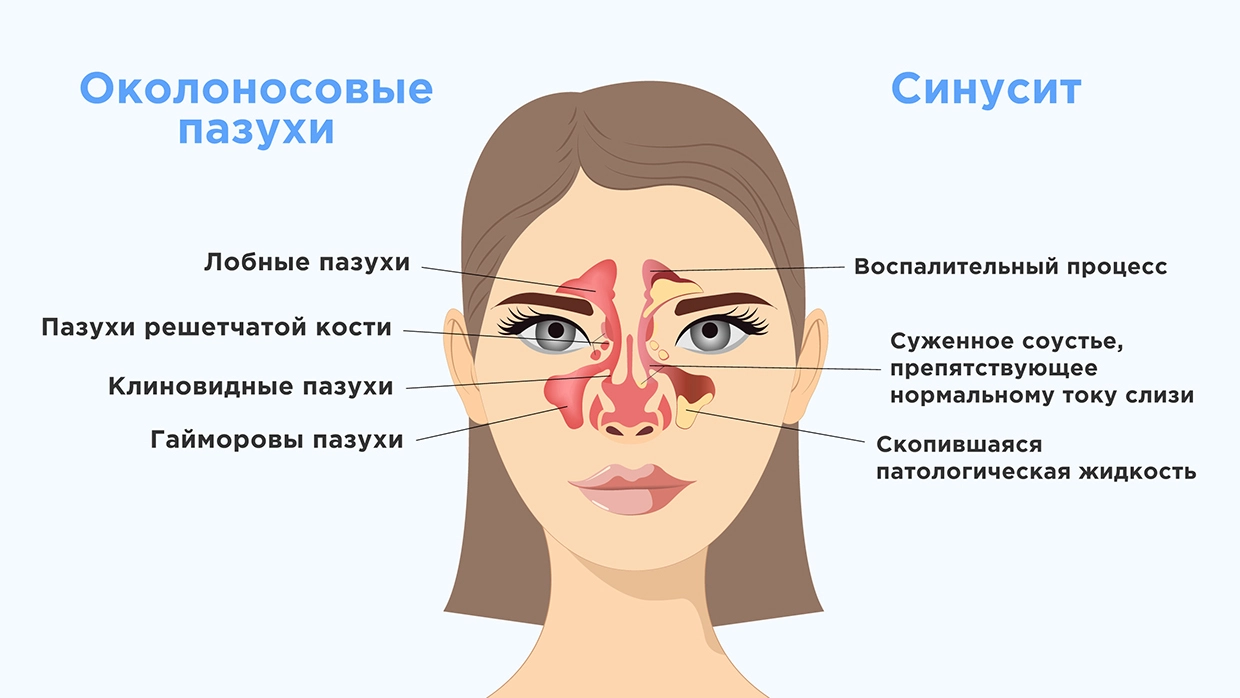 Синусит (гайморит) - симптомы, причины, лечение - Евромед