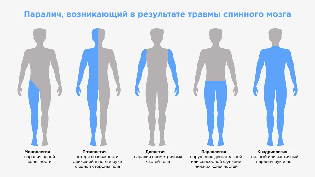 Травма позвоночника и спинного мозга - диагностика и лечение в Москве. Консультация врача.